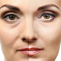 Blefaroplastia