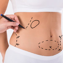 Abdominoplastia
