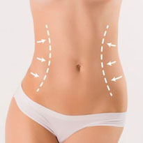 Lipoabdominoplastia