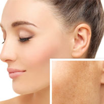 Secuelas de acné, melasma y rosácea